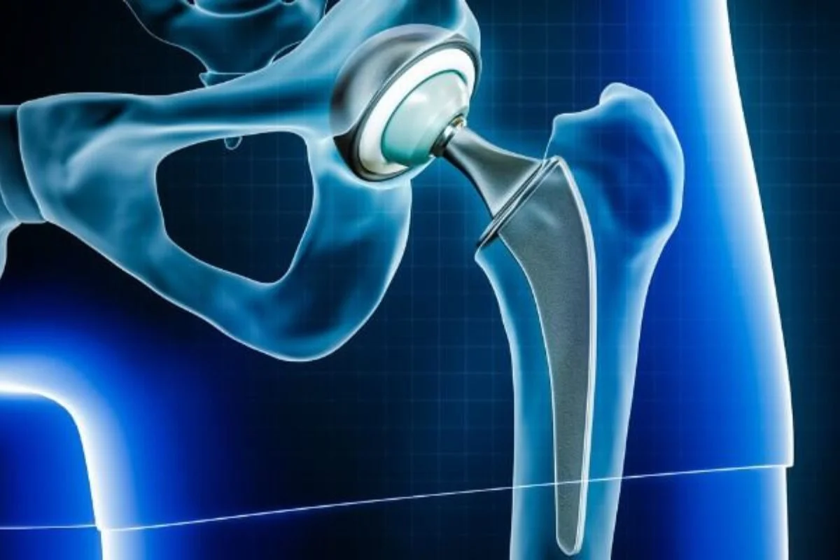 Hip Replacement in Abuja