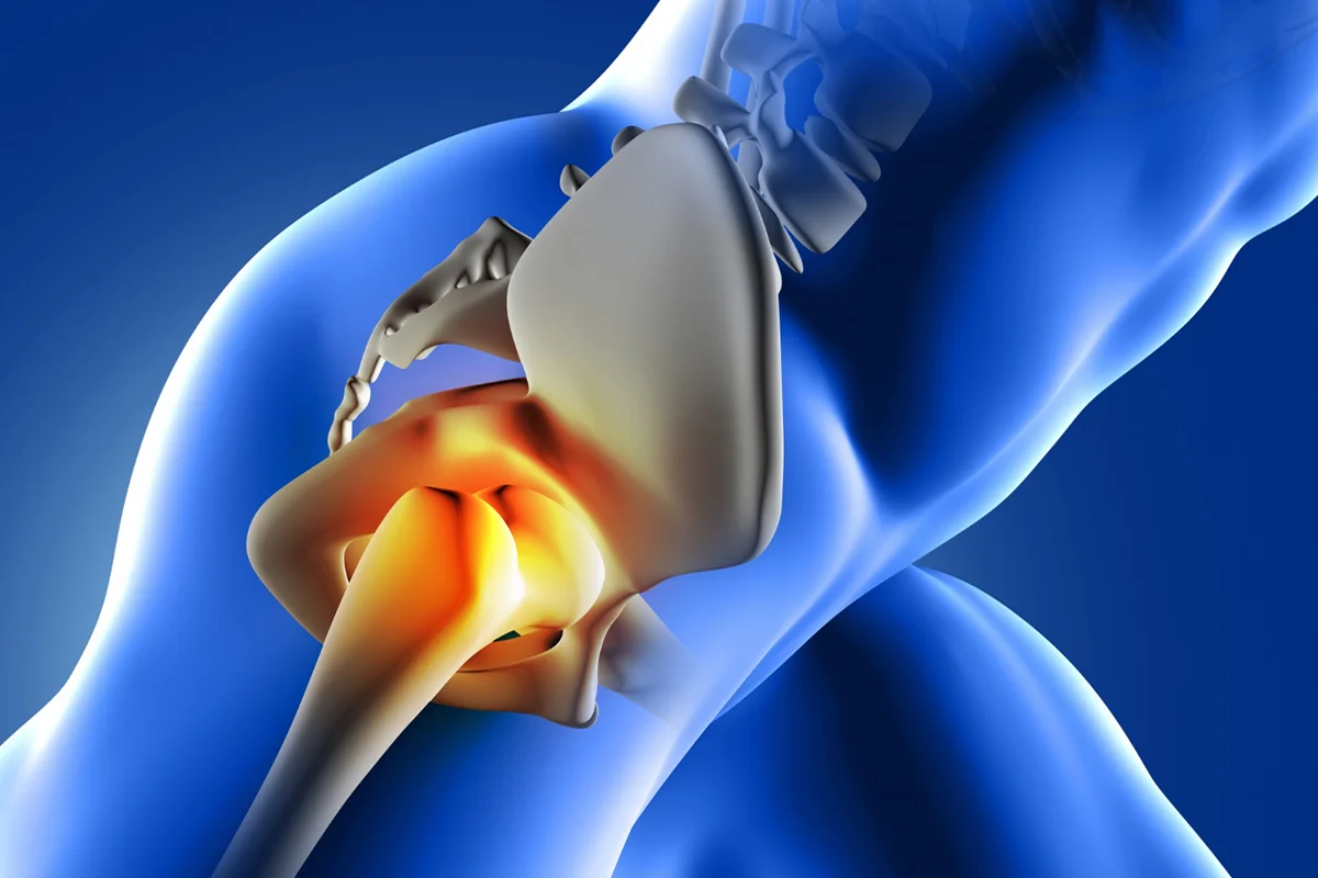 Hip replacement surgery in Nigeria