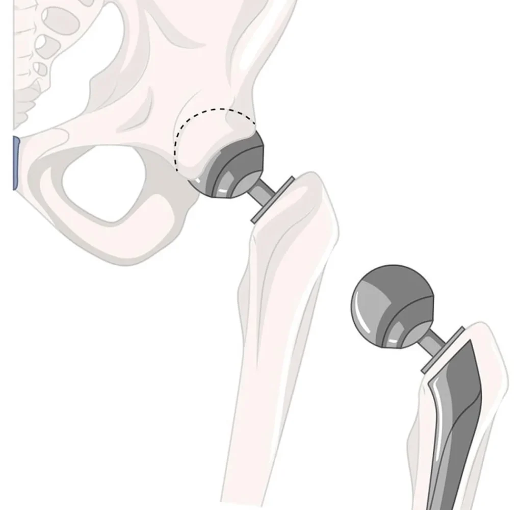 Hip replacement surgery in Nigeria
